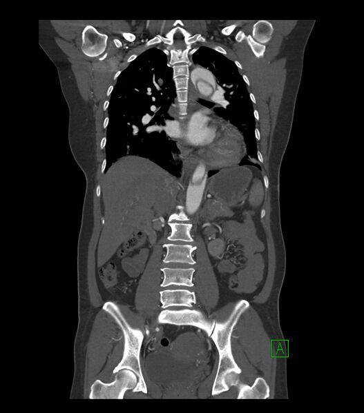 File:Aortic dissection with renal ischemia (Radiopaedia 76573-88338 C 19).jpg