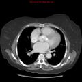 Aortic valve stenosis (Radiopaedia 14480-14423 C 7).jpg
