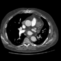 Aorto-coronary bypass graft aneurysms (Radiopaedia 40562-43157 A 58).png