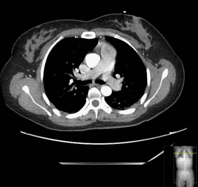 File:Appendicitis (CT angiogram) (Radiopaedia 154713-127660 Axial 208).jpg