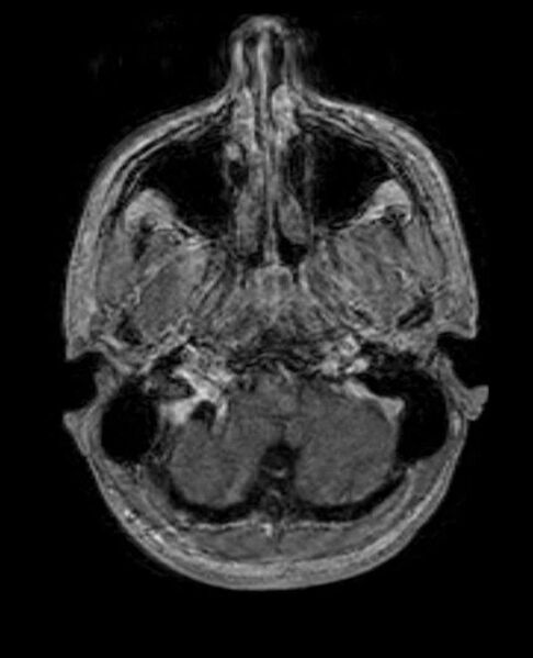File:Arachnoid cyst- extremely large (Radiopaedia 68741-78451 Axial T1 C+ 14).jpg