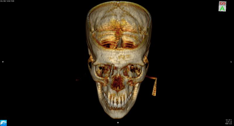 File:Arrow injury to the brain (Radiopaedia 72101-82607 3D bone 10).jpg