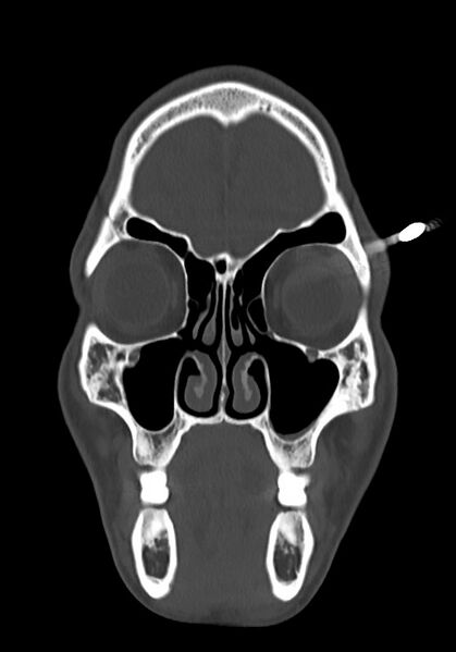 File:Arrow injury to the head (Radiopaedia 75266-86388 Coronal bone window 26).jpg