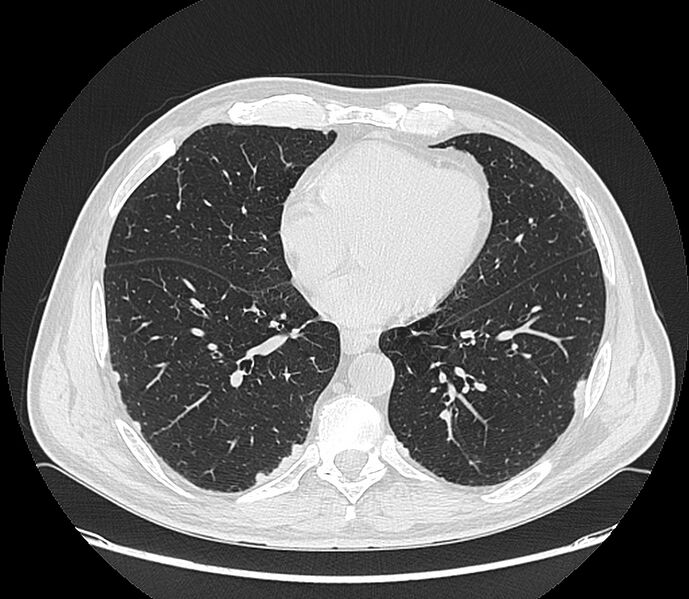 File:Asbestos pleural placques (Radiopaedia 57905-64872 Axial lung window 157).jpg