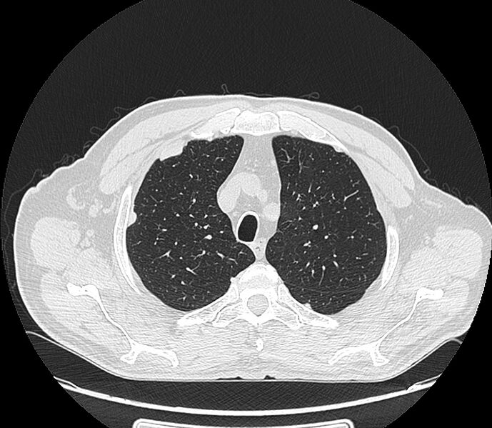 File:Asbestos pleural placques (Radiopaedia 57905-64872 Axial lung window 61).jpg