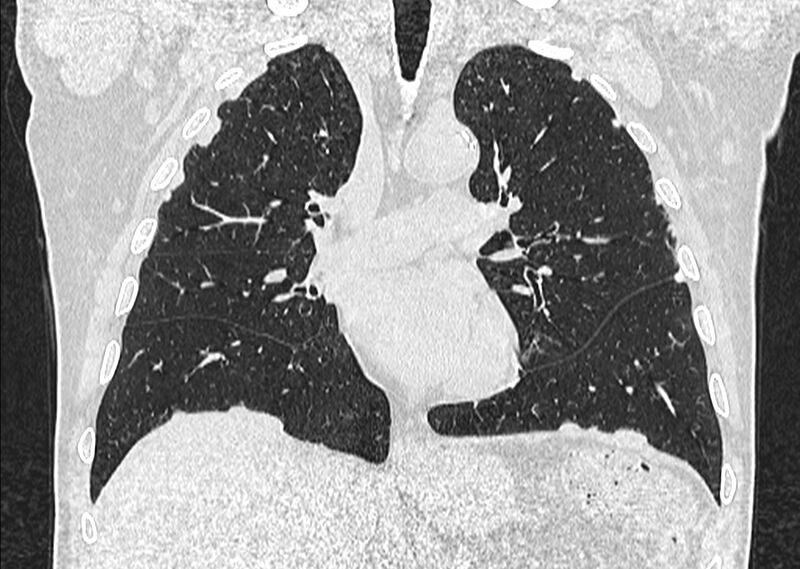 File:Asbestos pleural placques (Radiopaedia 57905-64872 Coronal lung window 135).jpg