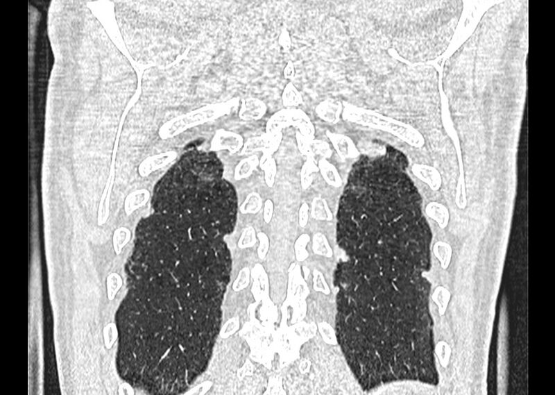 File:Asbestos pleural placques (Radiopaedia 57905-64872 Coronal lung window 259).jpg