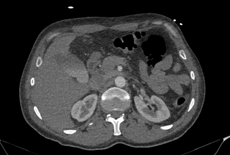 File:Ascending aortic aneurysm (Radiopaedia 86279-102297 C 75).jpg