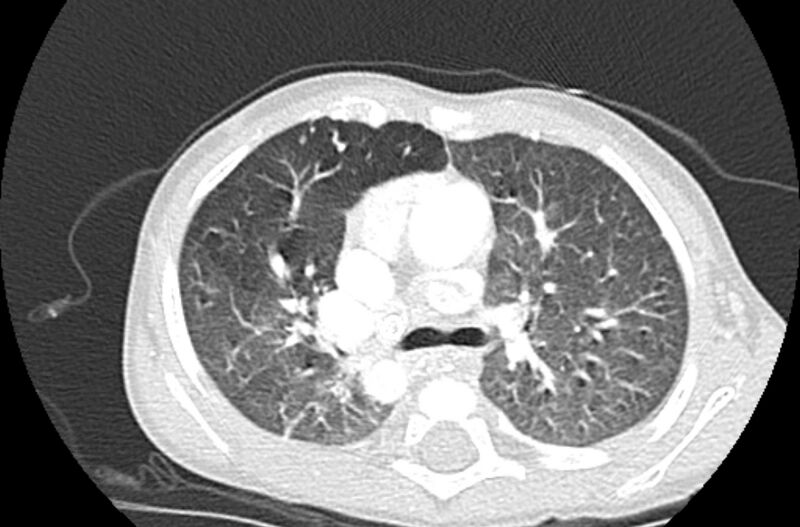 File:Asplenia syndrome (Radiopaedia 73083-83792 Axial lung window 25).jpg