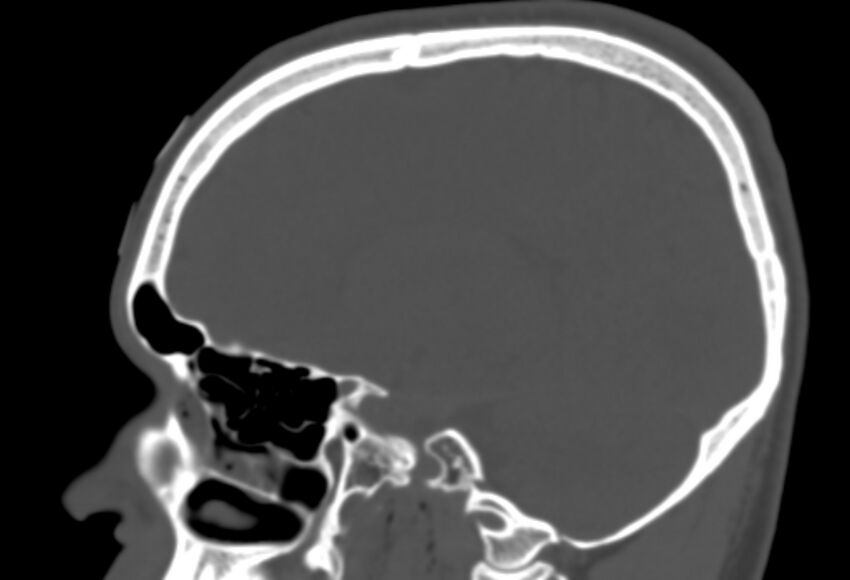 Asymptomatic occipital spur (Radiopaedia 87753-104201 Sagittal bone window 118).jpg