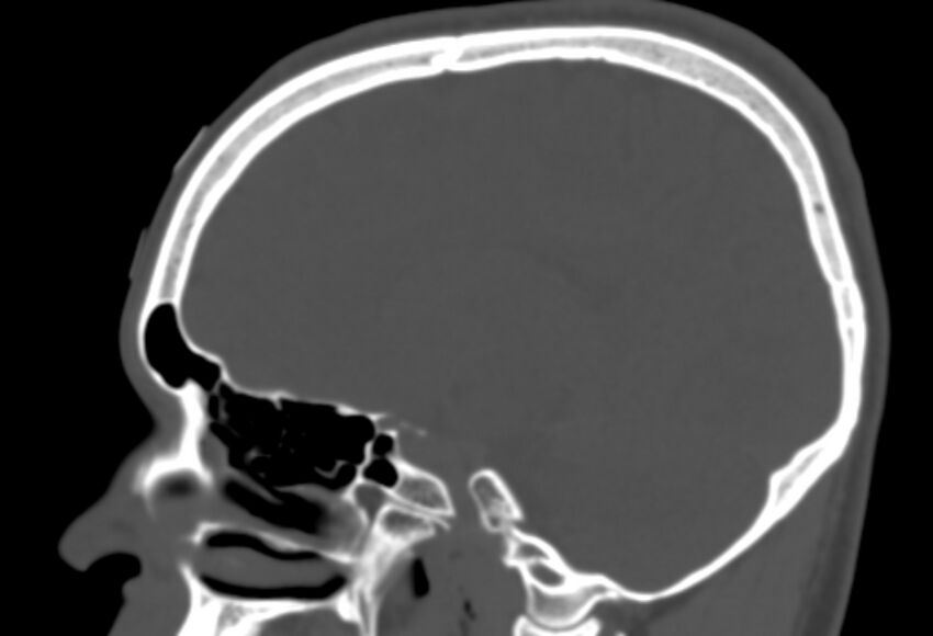 Asymptomatic occipital spur (Radiopaedia 87753-104201 Sagittal bone window 122).jpg