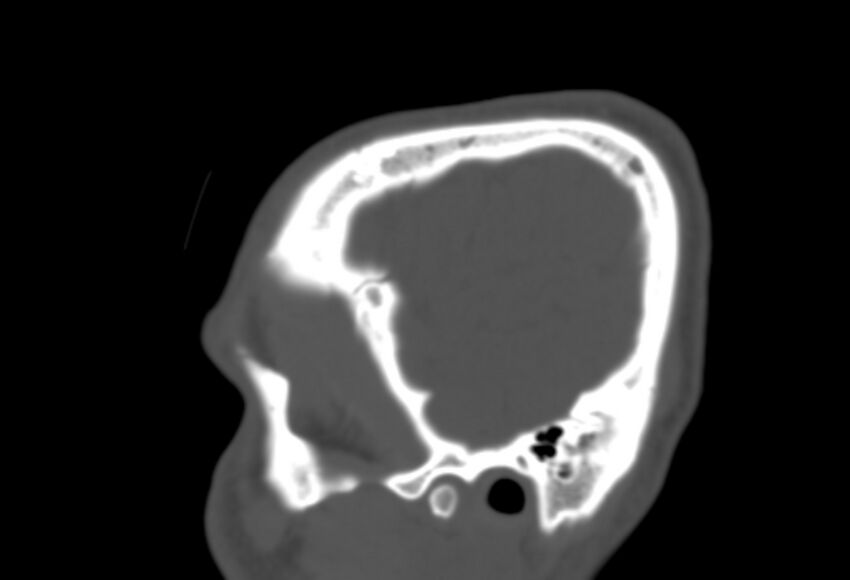 Asymptomatic occipital spur (Radiopaedia 87753-104201 Sagittal bone window 23).jpg