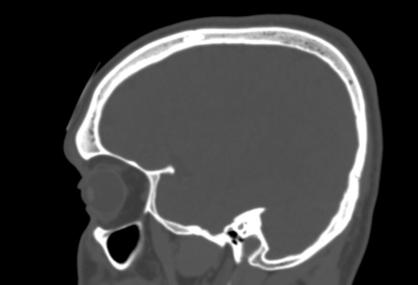 Asymptomatic occipital spur (Radiopaedia 87753-104201 Sagittal bone window 73).jpg