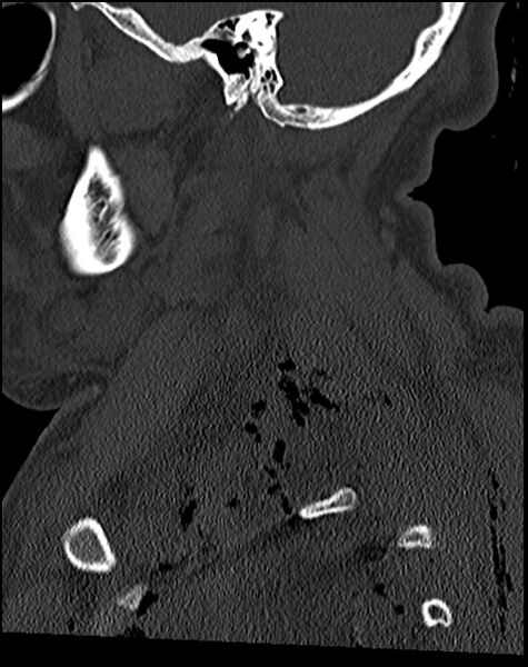 File:Atlanto-occipital dissociation - Traynelis type 1 (Radiopaedia 87570-103948 Sagittal bone window 25).jpg