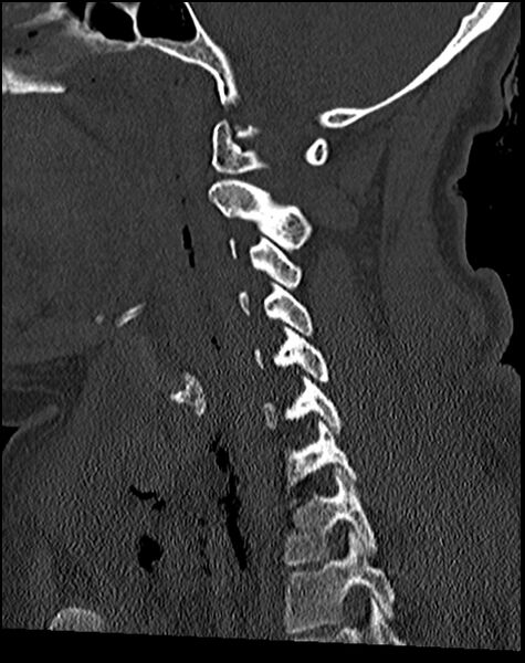 File:Atlanto-occipital dissociation - Traynelis type 1 (Radiopaedia 87570-103948 Sagittal bone window 40).jpg