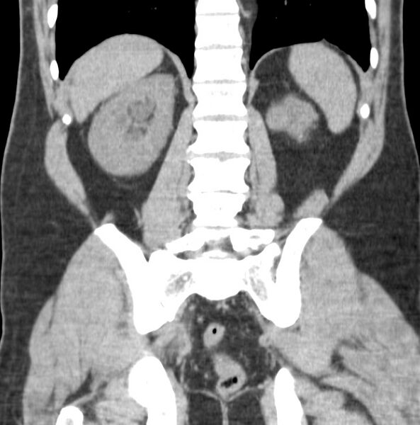 File:Atrophic kidney due to severe chronic obstructive hydronephrosis (Radiopaedia 40828-43474 Coronal non-contrast 9).jpg
