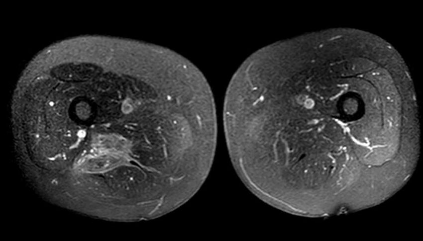 Atypical lipomatous tumor - thigh (Radiopaedia 68975-78734 Axial T1 C+ fat sat 56).jpg