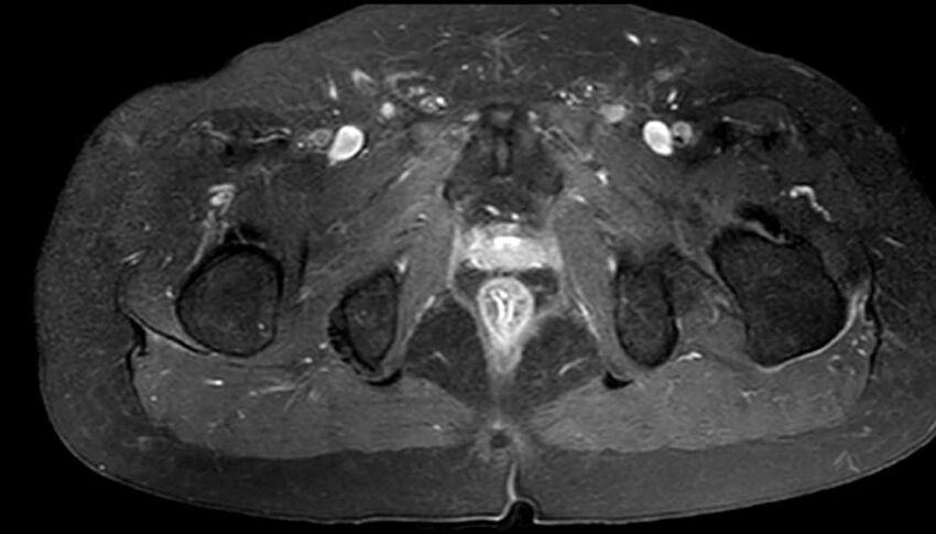 Atypical lipomatous tumor - thigh (Radiopaedia 68975-78734 Axial T1 C+ fat sat 87).jpg
