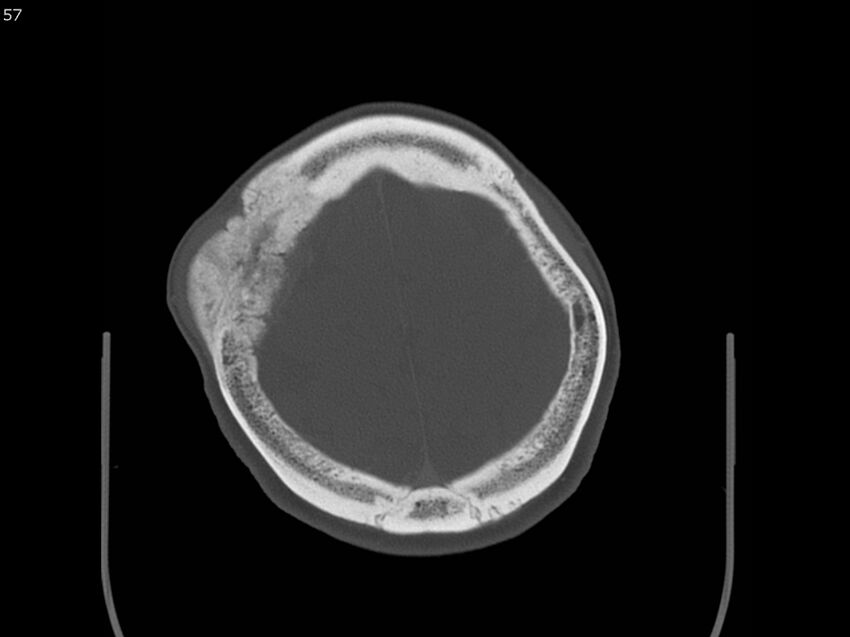 Atypical meningioma - intraosseous (Radiopaedia 64915-73867 Axial C+ bone window 57).jpg