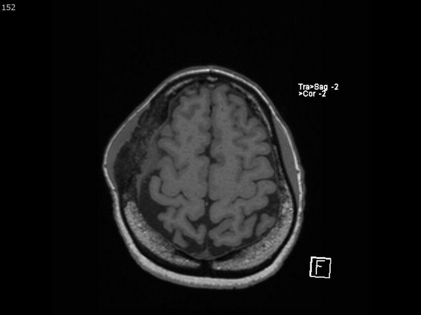 Atypical meningioma - intraosseous (Radiopaedia 64915-74572 Axial T1 152).jpg