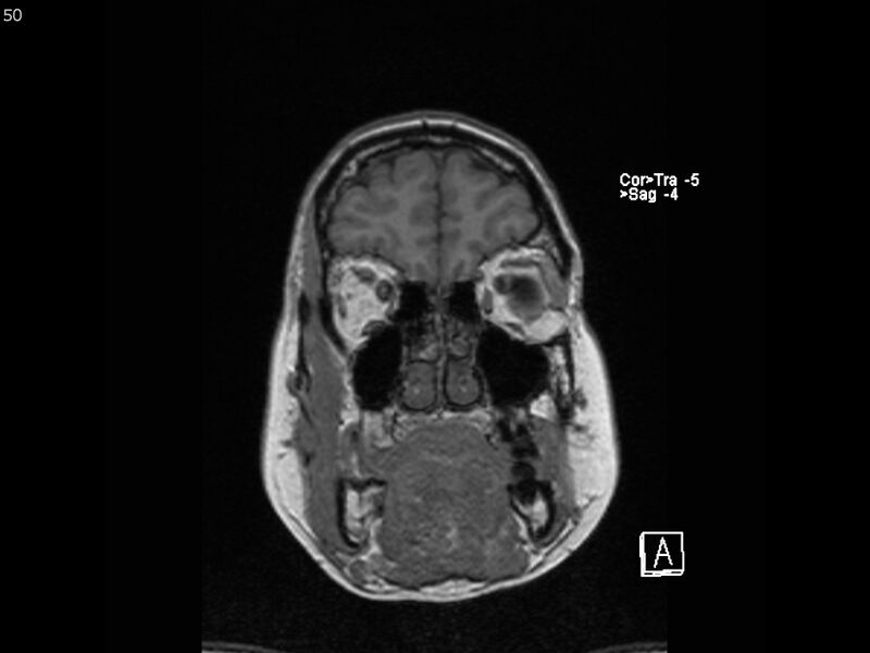 File:Atypical meningioma - intraosseous (Radiopaedia 64915-74572 Coronal T1 50).jpg