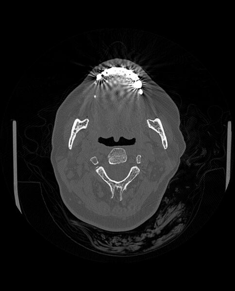 File:Automastoidectomy with labyrinthine fistula (Radiopaedia 84143-99411 Axial non-contrast 5).jpg