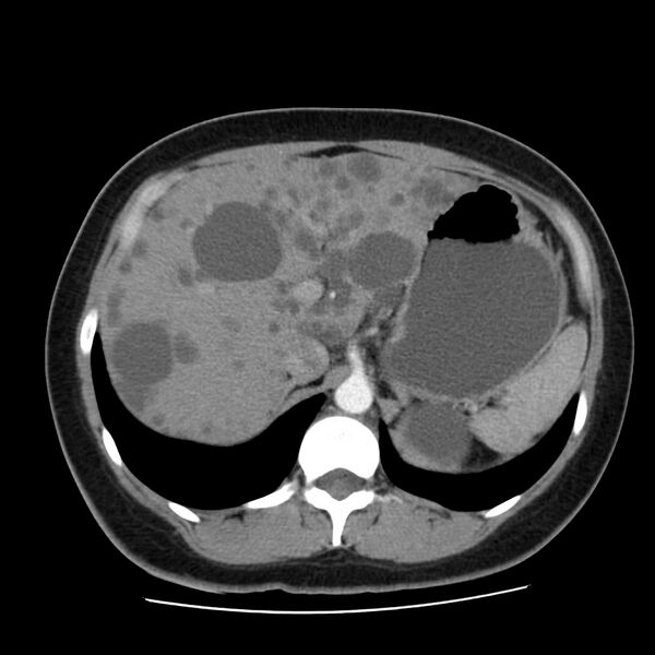 File:Autosomal dominant polycystic kidney disease (Radiopaedia 23061-23093 B 17).jpg