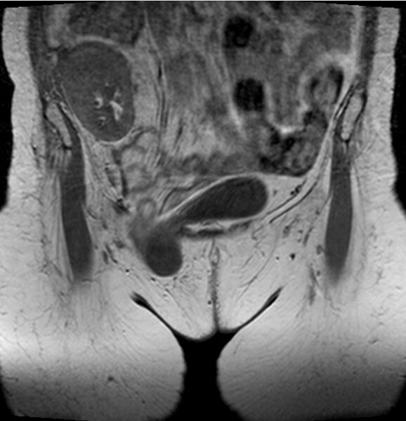 File:Avascular necrosis of the hip in renal transplant patient (Radiopaedia 7383-8236 Coronal T1 1).jpg
