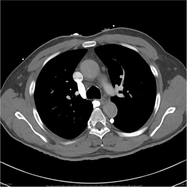 File:Azygos venous system anatomy (CT pulmonary angiography) (Radiopaedia 25928-26077 Axial C+ CTPA 30).jpg