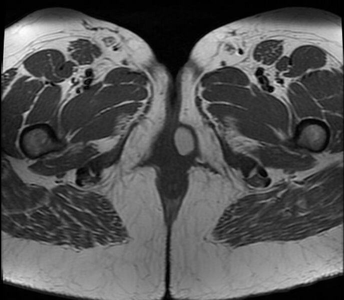 File:Bartholin gland cyst (Radiopaedia 11232-11597 Axial 2).jpg
