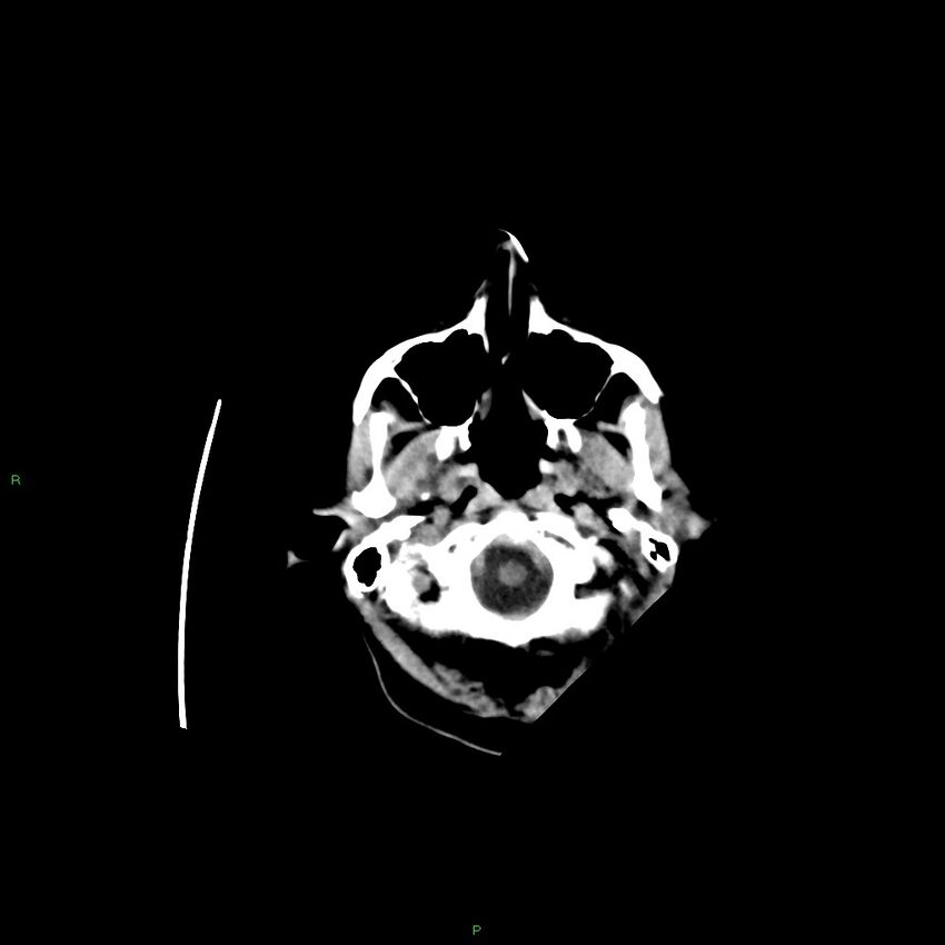 Basal ganglia hemorrhage (Radiopaedia 58350-65473 Axial non-contrast 43).jpg