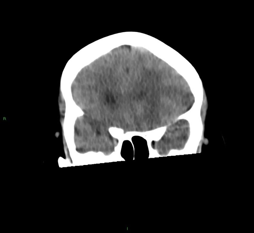 Basal ganglia hemorrhage (Radiopaedia 58759-65981 Coronal non-contrast 48).jpg