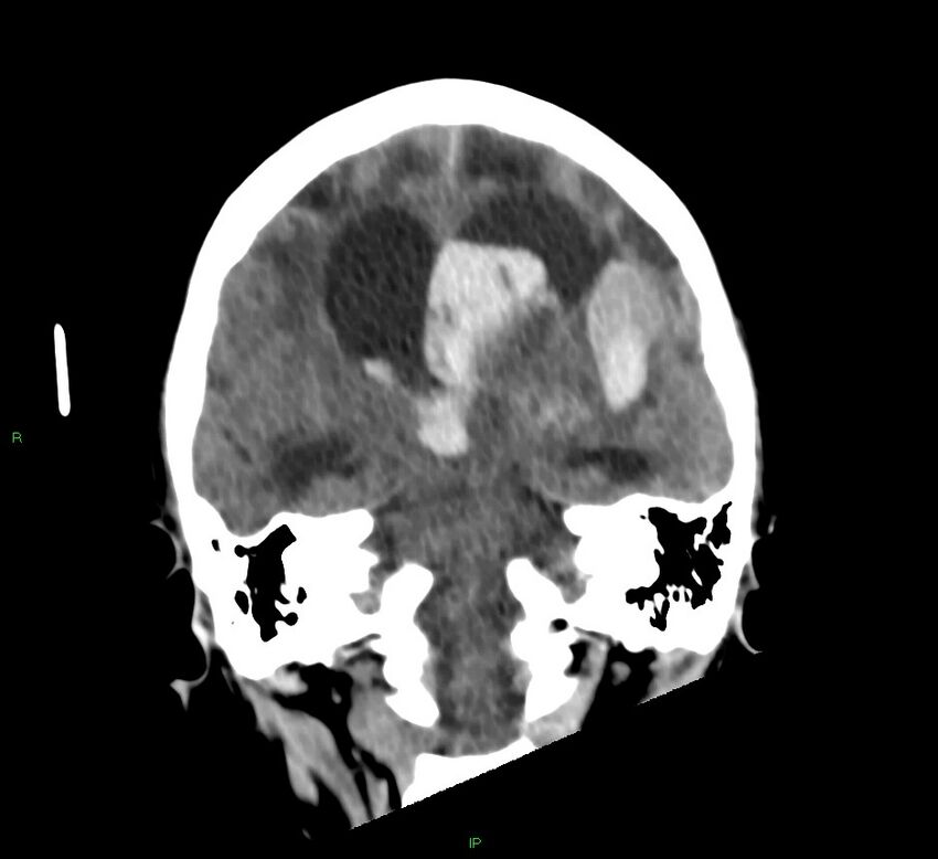 Basal ganglia hemorrhage (Radiopaedia 58766-65988 Coronal non-contrast 34).jpg