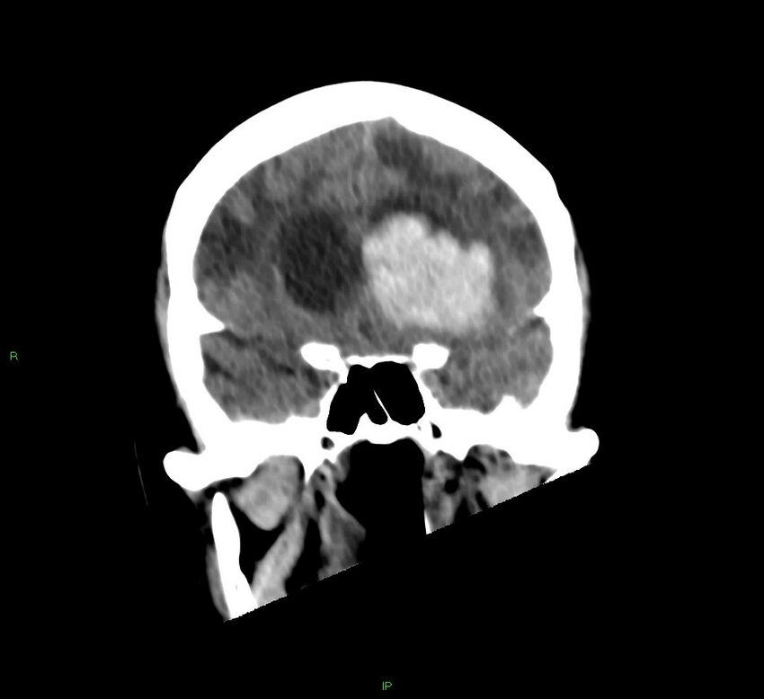 Basal ganglia hemorrhage (Radiopaedia 58766-65988 Coronal non-contrast 45).jpg