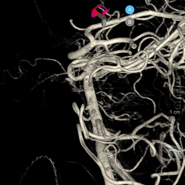 File:Basilar artery perforator aneurysm (Radiopaedia 82455-97734 3D view left VA 11).jpg