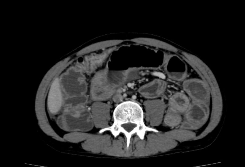 File:Behçet's disease- abdominal vasculitis (Radiopaedia 55955-62570 A 46).jpg