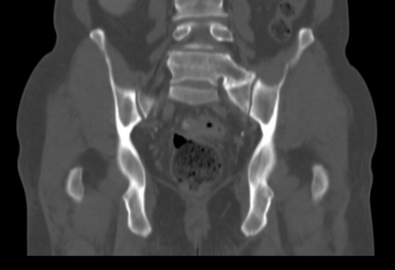 File:Bertolotti syndrome (Radiopaedia 58974-66235 Coronal bone window 15).jpg