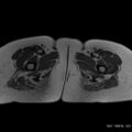 Bicornuate uterus- on MRI (Radiopaedia 49206-54297 Axial T1 20).jpg