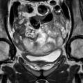 Bicornuate uterus (Radiopaedia 61974-70046 Coronal T2 5).jpg