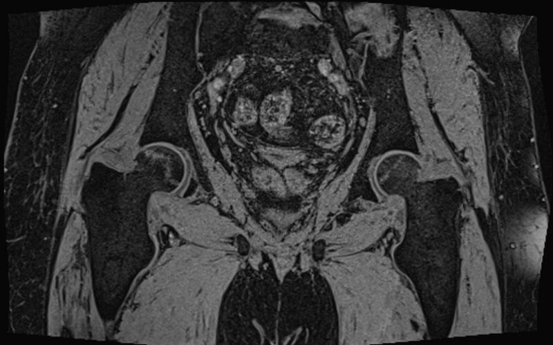 File:Bilateral avascular necrosis of femoral head (Radiopaedia 77116-89078 Coronal T2 we 23).jpg