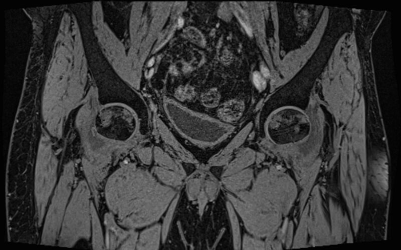 File:Bilateral avascular necrosis of femoral head (Radiopaedia 77116-89078 Coronal T2 we 60).jpg