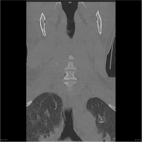 File:Bilateral cervical ribs (Radiopaedia 25868-26017 Coronal bone window 4).jpg