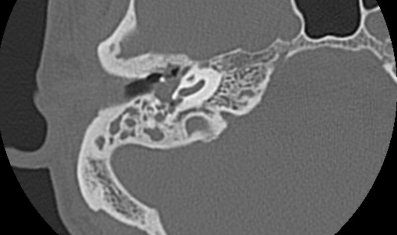 File:Bilateral cholesteatoma (Radiopaedia 54898-61172 Axial bone window 18).jpg