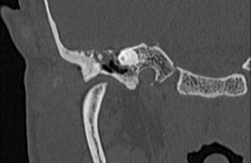 File:Bilateral cholesteatoma (Radiopaedia 54898-61172 Coronal bone window 21).jpg