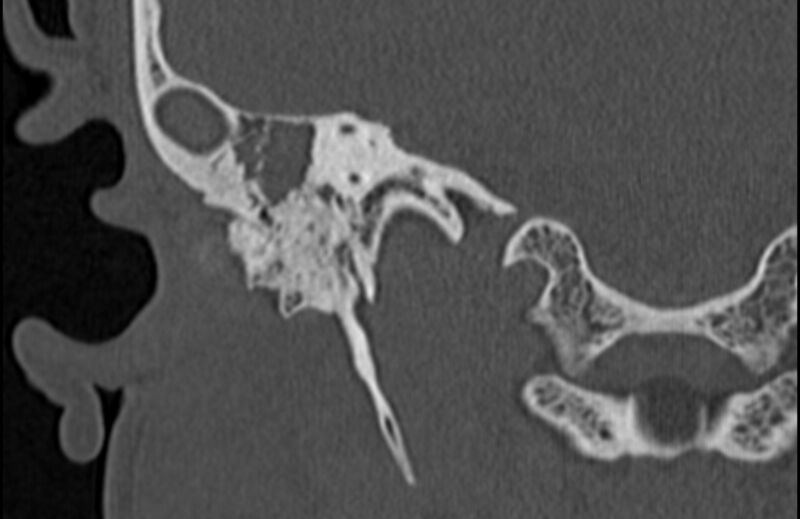 File:Bilateral cholesteatoma (Radiopaedia 54898-61172 Coronal bone window 53).jpg