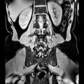 Bilateral conjoined nerve roots at different levels (Radiopaedia 73312-84063 Coronal WE 36).jpg