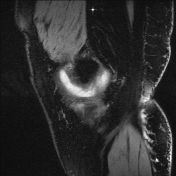 File:Bilateral focal pigmented villonodular synovitis (Radiopaedia 67643-77073 Sagittal T1 vibe 55).jpg