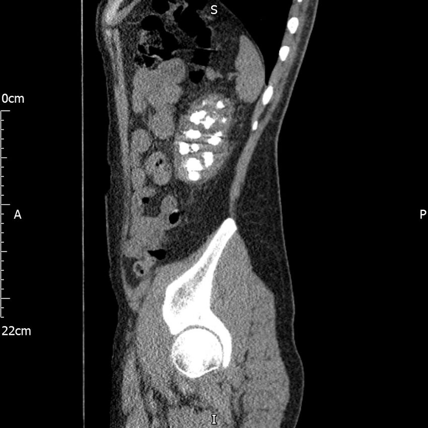 Bilateral medullary nephrocalcinosis with ureteric calculi (Radiopaedia 71269-81569 C 29).jpg