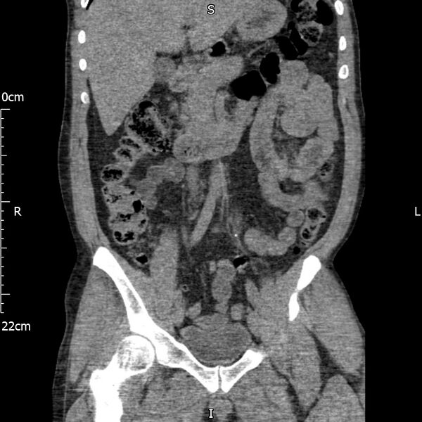 File:Bilateral medullary nephrocalcinosis with ureteric calculi (Radiopaedia 71269-81569 Coronal non-contrast 28).jpg