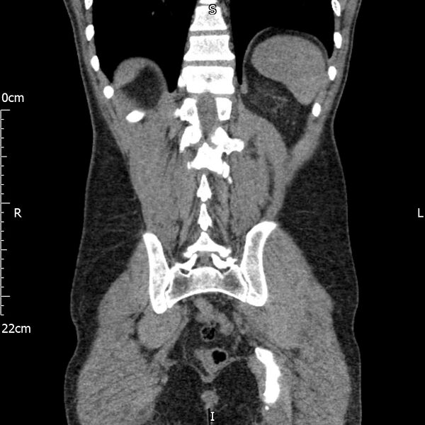 File:Bilateral medullary nephrocalcinosis with ureteric calculi (Radiopaedia 71269-81569 Coronal non-contrast 57).jpg